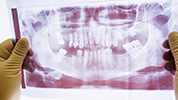 歯周基本検査